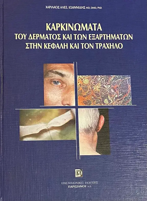 Καρκινώματα του Δέρματος και των Εξαρτημάτων στην Κεφαλή και τον Τράχηλο Καρκινώματα του Δέρματος και των Εξαρτημάτων στην Κεφαλή και τον Τράχηλο