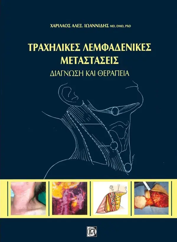 Τραχηλικές Λεμφαδενικές Μεταστάσεις – Διάγνωση και Θεραπεία Τραχηλικές Λεμφαδενικές Μεταστάσεις - Διάγνωση και Θεραπεία